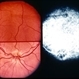 Foveal Hypoplasia